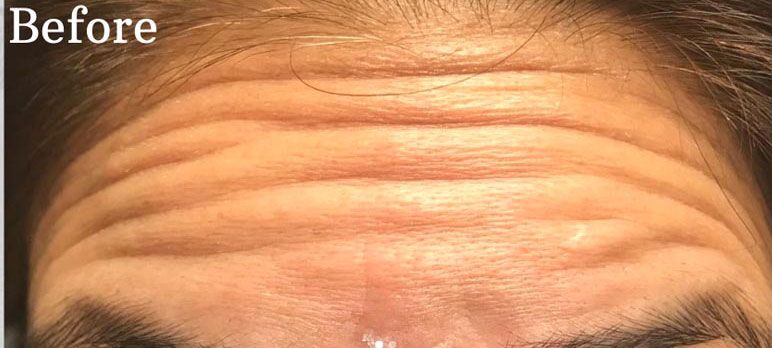 Botox | Broward ENT Services Broward ENT Services